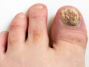 Malowanie paznokci z grzybicą – jak zadbać o zdrowie i estetykę?