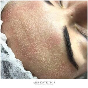 Kosmetyki po mikrodermabrazji – jak dbać o skórę po zabiegu?